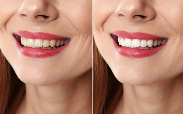 Eleven tips to treat white spots on teeth Eleven tips to treat white spots on teeth